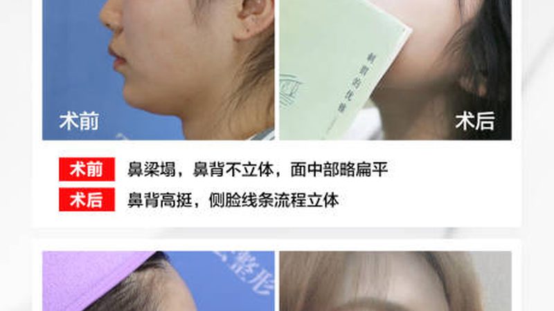 玻尿酸与肉毒素：揭秘进口品牌背后的技术奥秘