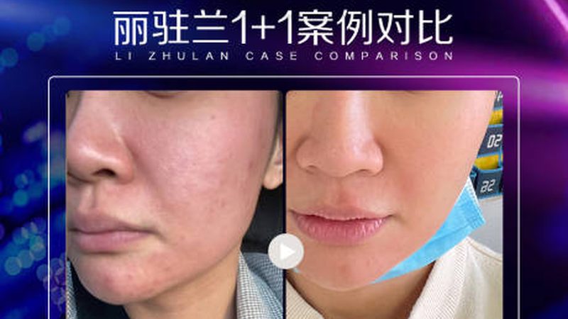 玻尿酸注射，如何选择厂家直供的产品？**