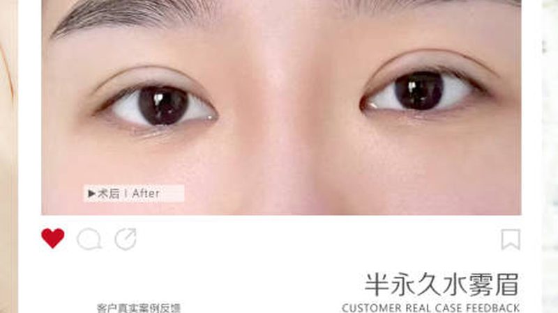 广州光子嫩肤团购机器参数对比